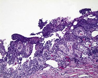 FIG. 29.14, The epithelium is replaced diffusely by sebaceous carcinoma. The papillary growth of tumor may be mistaken for papillary conjunctivitis, both histologically and clinically.