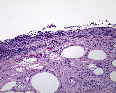 FIG. 29.15, At the left margin of the micrograph, the epithelium is thick and architecturally disorganized, typical of sebaceous carcinoma. Toward the right edge of the micrograph, the epithelium has sloughed. If the entire biopsy showed a sloughed epithelium, one might be tempted to render a diagnosis of ocular cicatricial pemphigoid, which can mimic sebaceous carcinoma clinically. Absence of the conjunctival epithelium in a clinical setting suspicious for sebaceous carcinoma should likely be viewed with caution when rendering histologic interpretations.