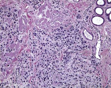 FIG. 29.16, Small congenital nevus of the eyelid. Nevus cells are identified near the skeletal muscle of the orbicular oculi and near the glands of Moll (upper right).