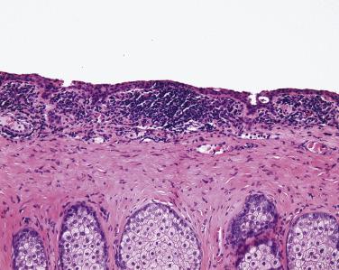 FIG. 29.17, The palpebral conjunctiva. Note the presence of goblet cells within the epithelium. The subepithelial lymphocytes are normally present in this location. Note that the densely packed fibrous connective tissue of the tarsus contains the meibomian glands.