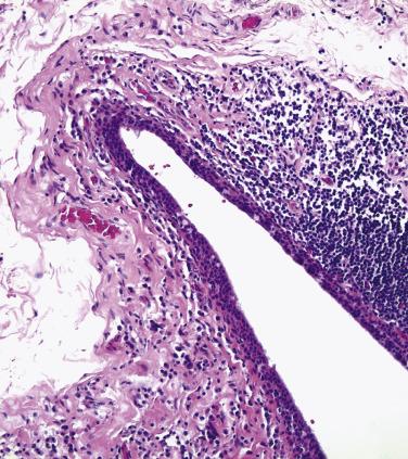 FIG. 29.18, The conjunctival fornix. The epithelium is arranged in a pseudostratified columnar architecture and goblet cells are numerous. It is normal for lymphocytes to be situated in this location.