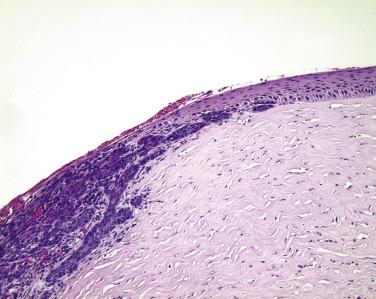 FIG. 29.19, The limbus. Basal cell carcinoma has dissected onto the surface of the eye (to the left ). Note that the tumor remains subepithelial as it encroaches onto the cornea and does not invade into the stroma. Bowman layer, a thin acellular band of connective tissue just beneath the epithelium, is an effective barrier to the penetration of tumors into the corneal stroma.