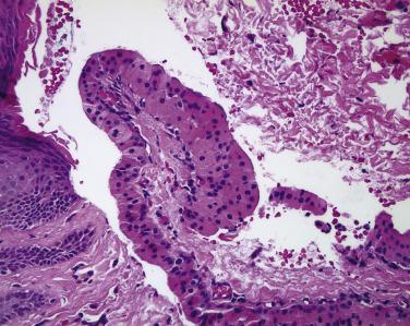 FIG. 29.20, Oncocytoma of the caruncle. The neoplasm has arisen from apocrine glands normally present in this location.