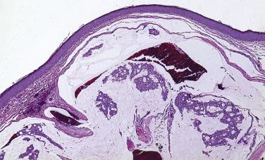 FIG. 29.2, Scanning magnification of primary mucinous carcinoma of the eyelid. Note the neoplastic cells apparently suspended in pools of mucin.