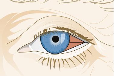 FIG. 29.21, Schematic for the gross examination of conjunctival neoplasm resected at the limbus. Sections should be taken perpendicular to the limbus and parallel to the superior and inferior resection margins.