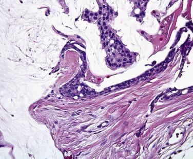 FIG. 29.3, Higher magnification of the micrograph in Fig. 29.2 . Some of the tumor cells line thick collagenous trabecula.