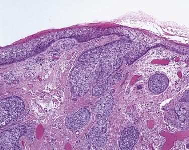 FIG. 29.4, Sebaceous carcinoma originating in a gland of Zeis, associated with an eyelash. The overlying epidermis appears thick and disorganized secondary to diffuse pagetoid growth of tumor cells.