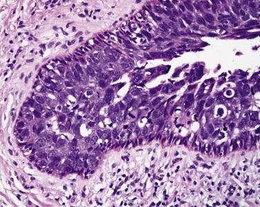 FIG. 29.6, Higher magnification of the micrograph in Fig. 29.5 illustrating sebaceous carcinoma in the lacrimal canaliculus. Smudging of the nuclear features is characteristic of intraepithelial sebaceous carcinoma.