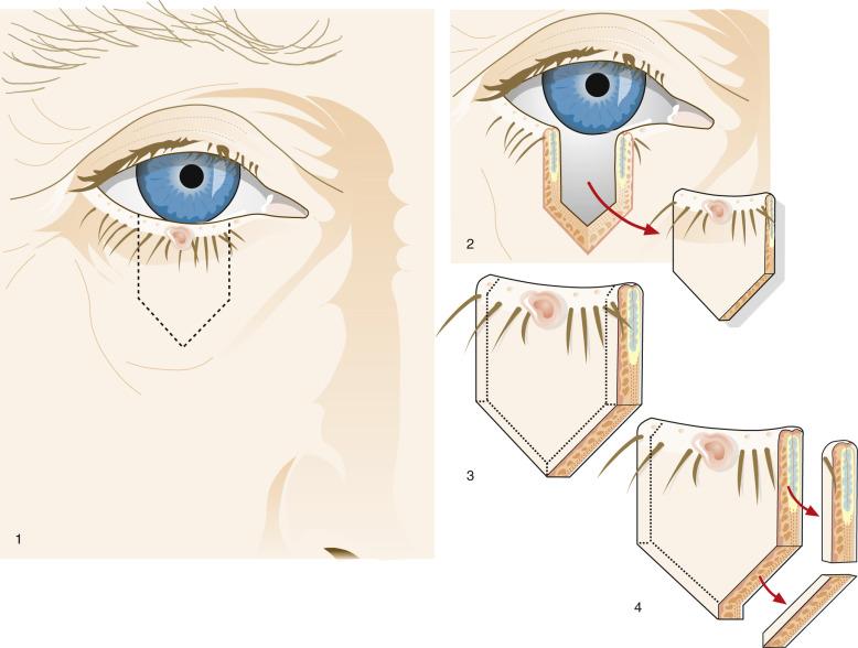 FIG. 29.7, Schematic drawing illustrating the steps in the sampling of margins for a neoplasm of the eyelid margin (1). Typically, a pentagon of tissue is resected (2) —the debulking layer (3). Strips of tissue along the four margins of resection—medial, lateral, and the two inferior margins—may be submitted separately by some surgeons. If separate margins are not submitted with the debulking layer, pathologists should remove and dissect these margins (3–4).