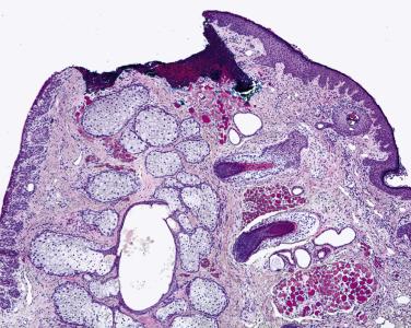 FIG. 29.8, In this micrograph, the surgeon has debrided the mucocutaneous junction of the eyelid, as evidenced by the presence of blood in this region. At other times, the mucocutaneous junction may not appear on the slide because the tissue section was embedded in the block such that the microtome section plane did not capture this critical zone. In this case, the histology technician should be asked to reembed the specimen or cut deeper sections until the mucocutaneous junction can be visualized and evaluated.