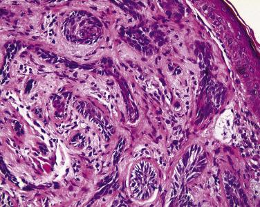 FIG. 29.9, Basal cell carcinoma of the sclerosing type. Note the thin strands of tumor entrapped between prominent bundles of collagen.