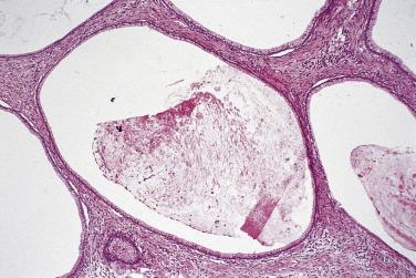 FIG. 13A.15, Mucinous cystadenoma. This multilocular cystic neoplasm is lined by a single layer of columnar mucinous cells.