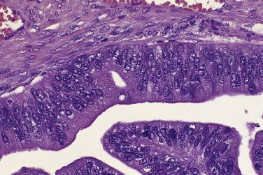 FIG. 13A.21, Mucinous carcinoma. Most of the cells have dense eosinophilic cytoplasm. The nuclei are stratified, large, and vesicular, with coarse chromatin, and some contain prominent nucleoli.