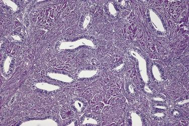 FIG. 13A.25, Endometrioid adenofibroma. Glands lined by a single layer of benign endometrial-type cells grow in dense fibrous stroma.