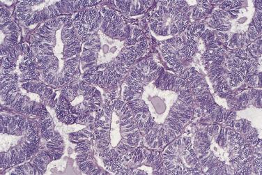 FIG. 13A.27, Endometrioid carcinoma. The back-to-back glands are lined by columnar cells with stratified hyperchromatic nuclei.