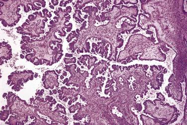 FIG. 13A.3, Borderline serous tumor. The branching papillae are covered by proliferating columnar cells, some of which are detached into the cyst lumen.