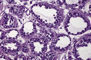 FIG. 13A.36, Clear cell carcinoma, tubulocystic pattern. Tubules are lined by cuboidal cells with clear cytoplasm and atypical hyperchromatic nuclei.