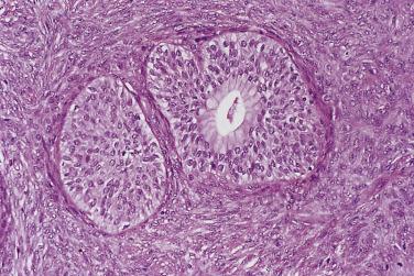 FIG. 13A.38, Benign Brenner tumor. Nests of transitional epithelial cells are surrounded by fibrous stroma. Metaplastic columnar endocervical-like mucinous cells line a microcyst in the nest on the right.