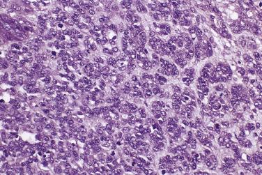 FIG. 13A.42, Small cell carcinoma of neuroendocrine type. This tumor arose adjacent to a mucinous carcinoma. The tumor cells have scanty cytoplasm and uniform hyperchromatic round nuclei, and there are numerous mitotic figures.