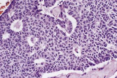 FIG. 13A.43, Adult granulosa cell tumor. The cells are monotonous with uniform grooved nuclei. Note the Call-Exner bodies. These are microcystic spaces that contain eosinophilic secretions or cellular debris. They are lined by palisaded granulosa cells.