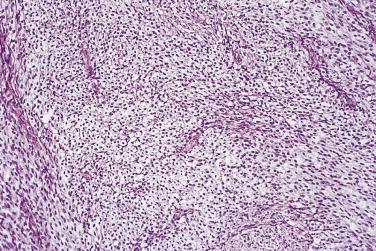 FIG. 13A.51, Thecoma. Nests of pale, vacuolated spindle cells with small central nuclei.