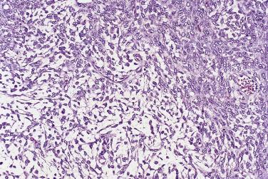 FIG. 13A.55, Thecomatous tumor associated with sclerosing peritonitis. Marked edema is present. The theca cells are plump, and many have conspicuous pink cytoplasm. Numerous mitotic figures are present.