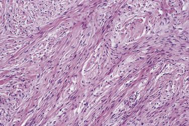 FIG. 13A.56, Fibroma. Bland spindled fibroblasts are separated by abundant eosinophilic collagen.