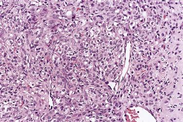 FIG. 13A.58, Sclerosing stromal tumor. Cellular region composed of plump rounded cells.