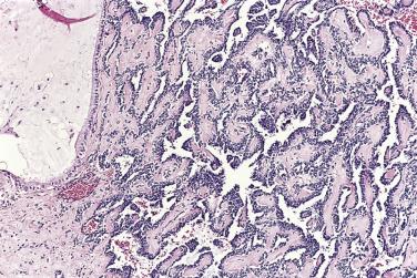 FIG. 13A.61, Moderately differentiated Sertoli-Leydig cell tumor. Branching retiform tubules with a focal papillary appearance.