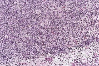FIG. 13A.62, Moderately differentiated Sertoli-Leydig cell tumor. Sheetlike pattern composed of pale Sertoli cells, darkly stained immature stromal cells, and, at the periphery, nests of Leydig cells with conspicuous eosinophilic cytoplasm.