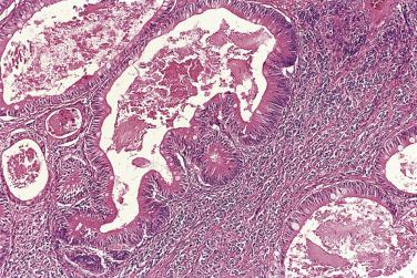 FIG. 13A.64, Moderately differentiated Sertoli-Leydig cell tumor with heterologous enteric epithelium. The large glands are lined by intestinal-type cells, including goblet cells. Typical features of Sertoli-Leydig cell tumor can be seen in the stroma between the enteric glands.