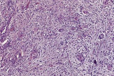 FIG. 13A.7, Noninvasive desmoplastic implant of borderline serous tumor. Scattered small nests of bland epithelial cells are surrounded by abundant fibrous stroma.