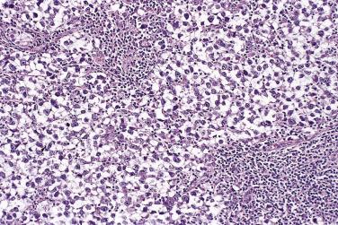 FIG. 13A.75, Dysgerminoma. Lobules of tumor cells with abundant clear cytoplasm are separated by fibrous septa that contain numerous lymphocytes.