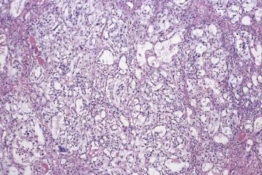 FIG. 13A.76, Yolk sac tumor. Typical microcystic or reticular pattern.