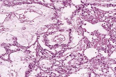 FIG. 13A.77, Yolk sac tumor. Endodermal sinus pattern with a Schiller-Duval body in the center of the field. A Schiller-Duval body is a papillary structure that grows into a cystic space. The papilla is covered by tumor cells and has a central capillary.