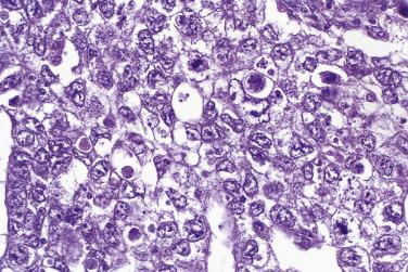 FIG. 13A.81, Embryonal carcinoma. Sheetlike growth of anaplastic malignant germ cells. Glands and syncytiotrophoblastic giant cells were present elsewhere in the tumor.