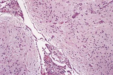 FIG. 13A.85, Glial implant in the omentum. Nodules of benign-appearing glial tissue are covered by peritoneum in this grade 0 implant.