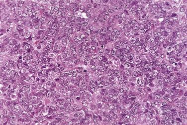 FIG. 13A.96, Small cell carcinoma. The tumor cells have scanty cytoplasm and monotonous small round or oval nuclei with fine chromatin and inconspicuous nucleoli.