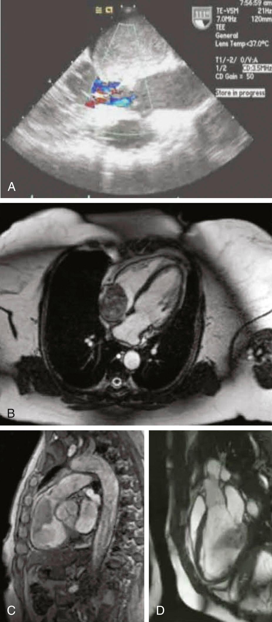 FIGURE 103-1, Myxomas of the heart. A, Echocardiography of giant left atrial myxoma. B, Magnetic resonance imaging of right atrial myxoma. C, Magnetic resonance imaging of right ventricular myxoma. D, Magnetic resonance imaging of left ventricular myxoma.