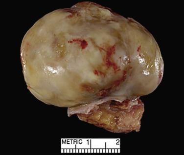 FIG. 2.1, Myxoma with stalk and smooth globular shape.