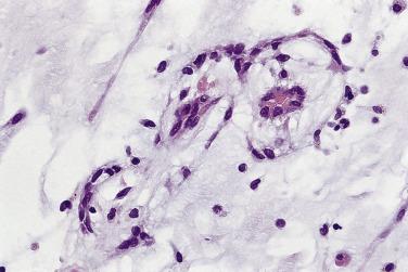 FIG. 2.11, Myxoma cells in small clusters partially cuffing capillaries.