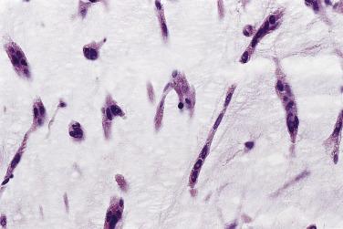 FIG. 2.12, Myxoma cells with an almost singular arrangement dispersed in the myxoid stroma.