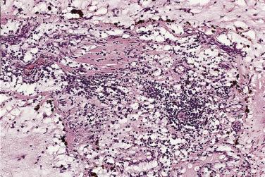 FIG. 2.15, Myxoma with large number of lymphocytes.