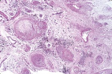 FIG. 2.16, Myxoma with dysplastic vessels in the stalk.