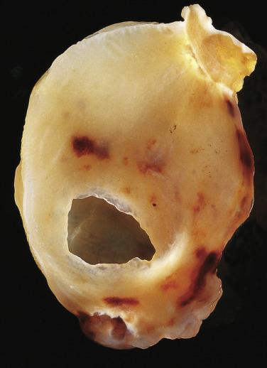 FIG. 2.17, Myxoma stromal liquefaction resulting in a “cyst” filled with clear fluid.