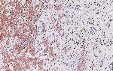 FIG. 2.18, Myxoma with hemosiderin-laden macrophages dispersed throughout the myxoid stroma adjacent to recent hemorrhage.