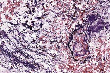 FIG. 2.19, Myxoma with stromal Gamna-Gandy bodies.