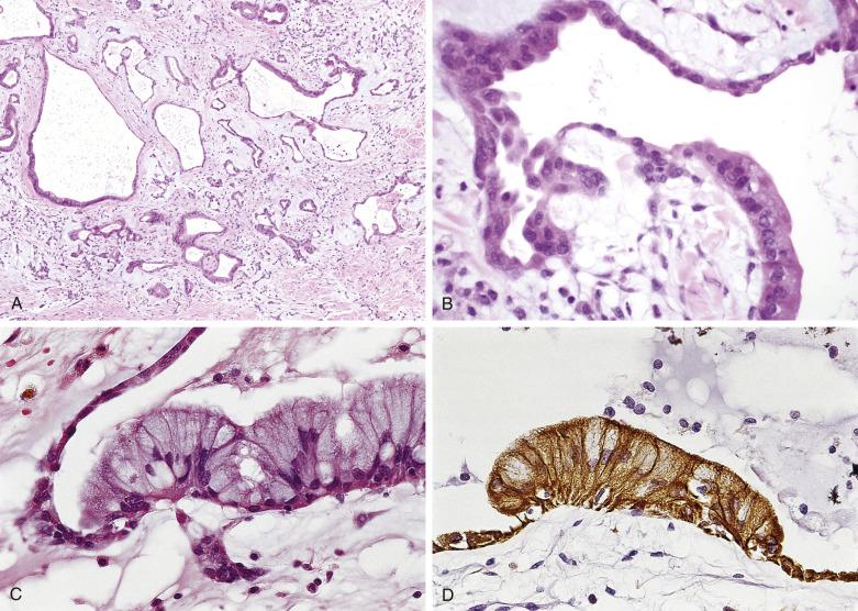 FIG. 2.20, Myxoma with glands (A–C) lined by alternating flat and columnar cells. The cells are reactive with antibodies to cytokeratin (D).