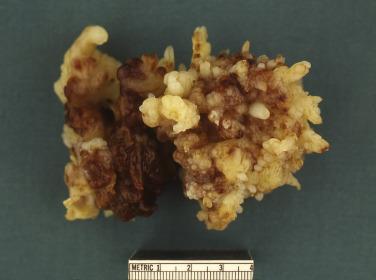 FIG. 2.2, Myxoma with papillae. Note that the papillae are broad and thick.