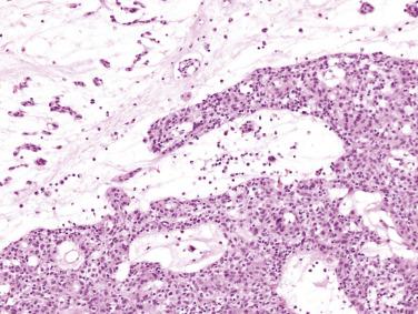 FIG. 2.21, Myxoma with thymic rest that has given rise to thymoma.